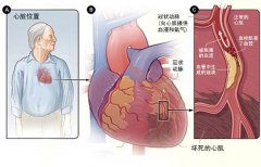 冠心病的起因是什么？