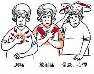 冠心病有哪些癥狀？(圖1)