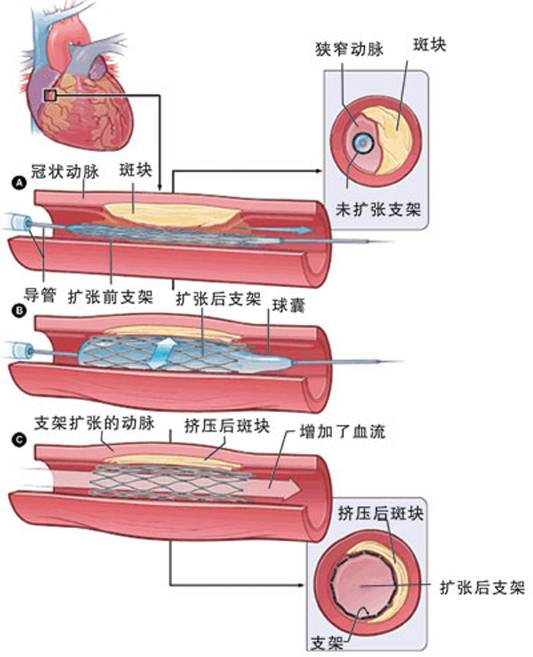 怎樣治療冠心??？(圖2)