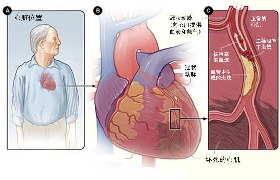 怎樣治療冠心??？(圖3)