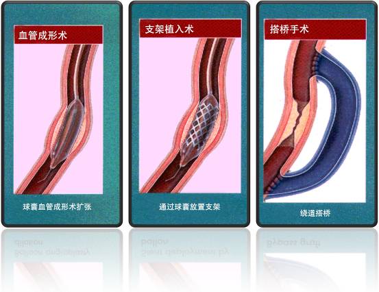 怎樣治療冠心?。?圖1)