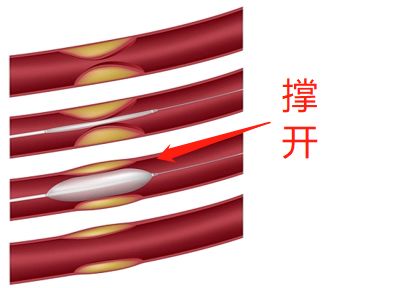 什么是藥物球囊？(圖2)